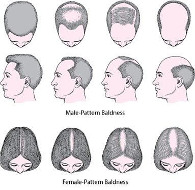 Custom Hair Loss